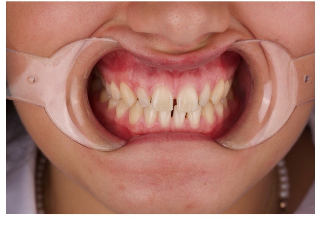 Aralıklı diş tedavisi öncesi hali. Dişler arasındaki boşluklar görülüyor.