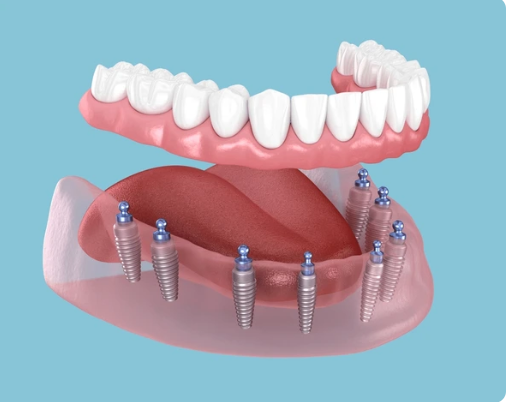 Komple İmplant Tedavisi