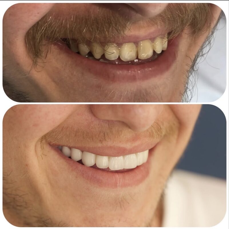 Zirkonyum Porselen: Avantajları ve Dezavantajları