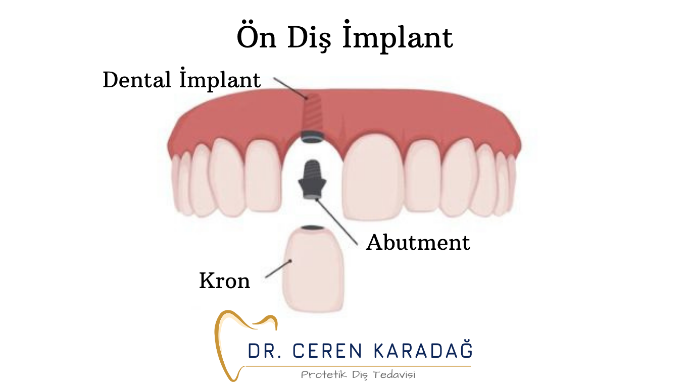 implant avantajları