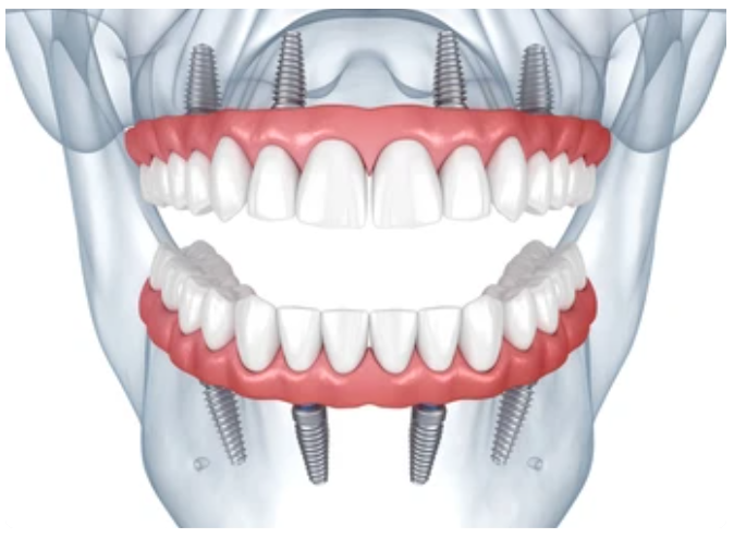 All On Four İmplant Tedavisi Nedir?