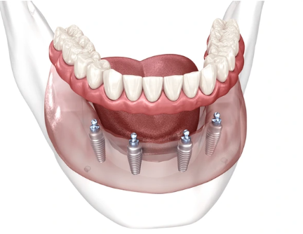 All on Four implant tedavisi uygulanan alt çene modelinde dört implantın yerleşimi