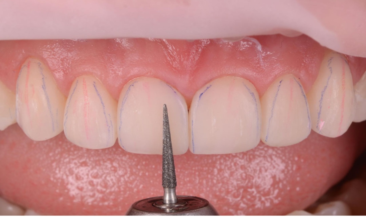 Diş hekimi, kompozit bonding işlemiyle ön dişlerde aralık kapatma ve estetik form düzeltme uygulaması yapıyor.