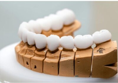 Zirkonyum porselen dişlerin çene modeli üzerindeki görünümü – estetik diş kaplama örneği.