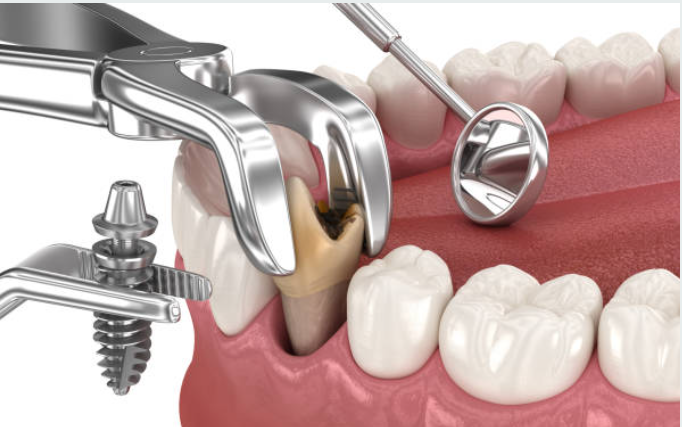 Diş Çekimiyle Aynı Anda İmplant Yapılır mı? Şartları ve Avantajları