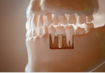 Çene kemiği içinde konumlandırılmış dental implantın görseli — diş çekimi sonrası implant yerleştirme (immediate implant) uygulamasını gösteriyor.