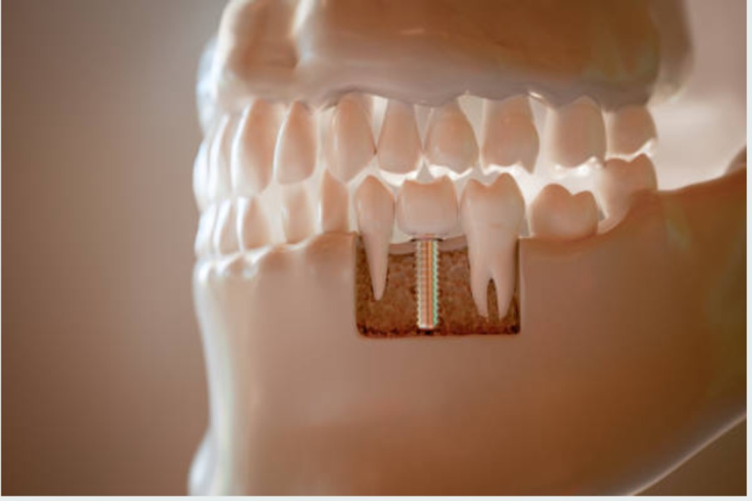 Çene kemiği içinde konumlandırılmış dental implantın görseli — diş çekimi sonrası implant yerleştirme (immediate implant) uygulamasını gösteriyor.