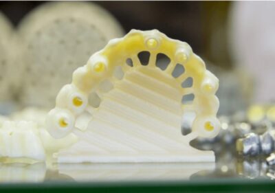 Zirkonyum porselen diş köprüsü uygulaması – Kadıköy Suadiye diş kliniğinde estetik ve dayanıklı zirkonyum kaplama tedavisi.