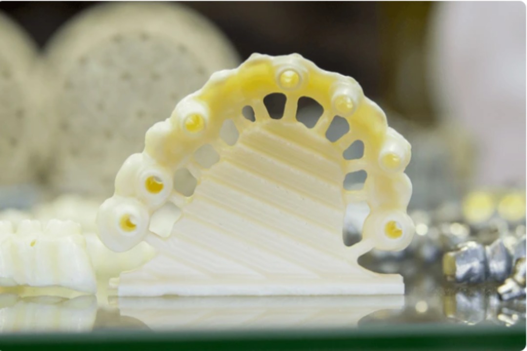 Zirkonyum porselen diş köprüsü uygulaması – Kadıköy Suadiye diş kliniğinde estetik ve dayanıklı zirkonyum kaplama tedavisi.