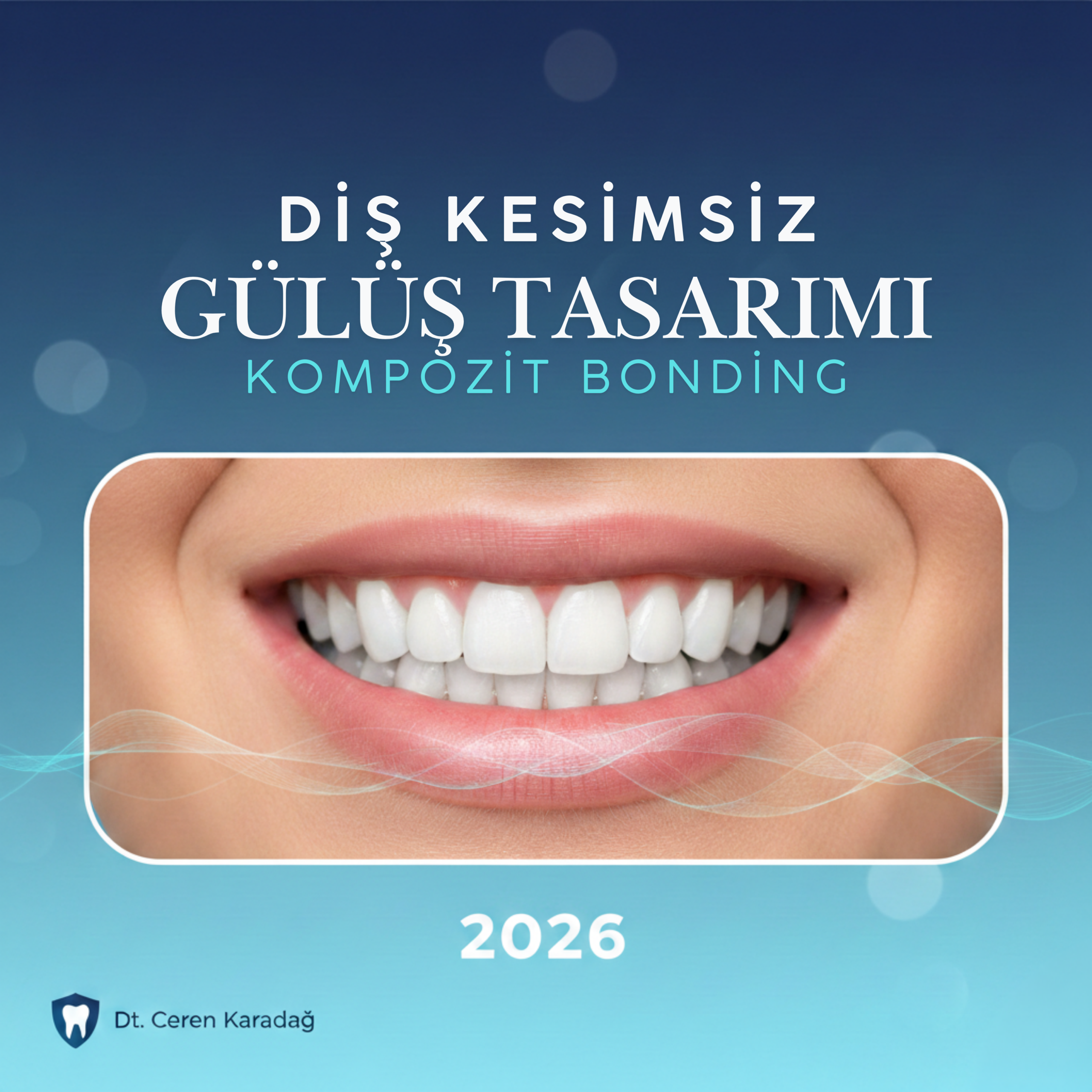 Diş kesimsiz gülüş tasarımı kompozit bonding