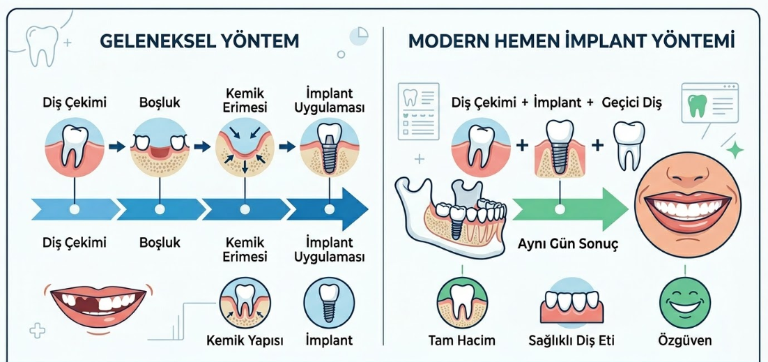 Diş Çekimi ve İmplant Aynı Anda Yapılır mı?