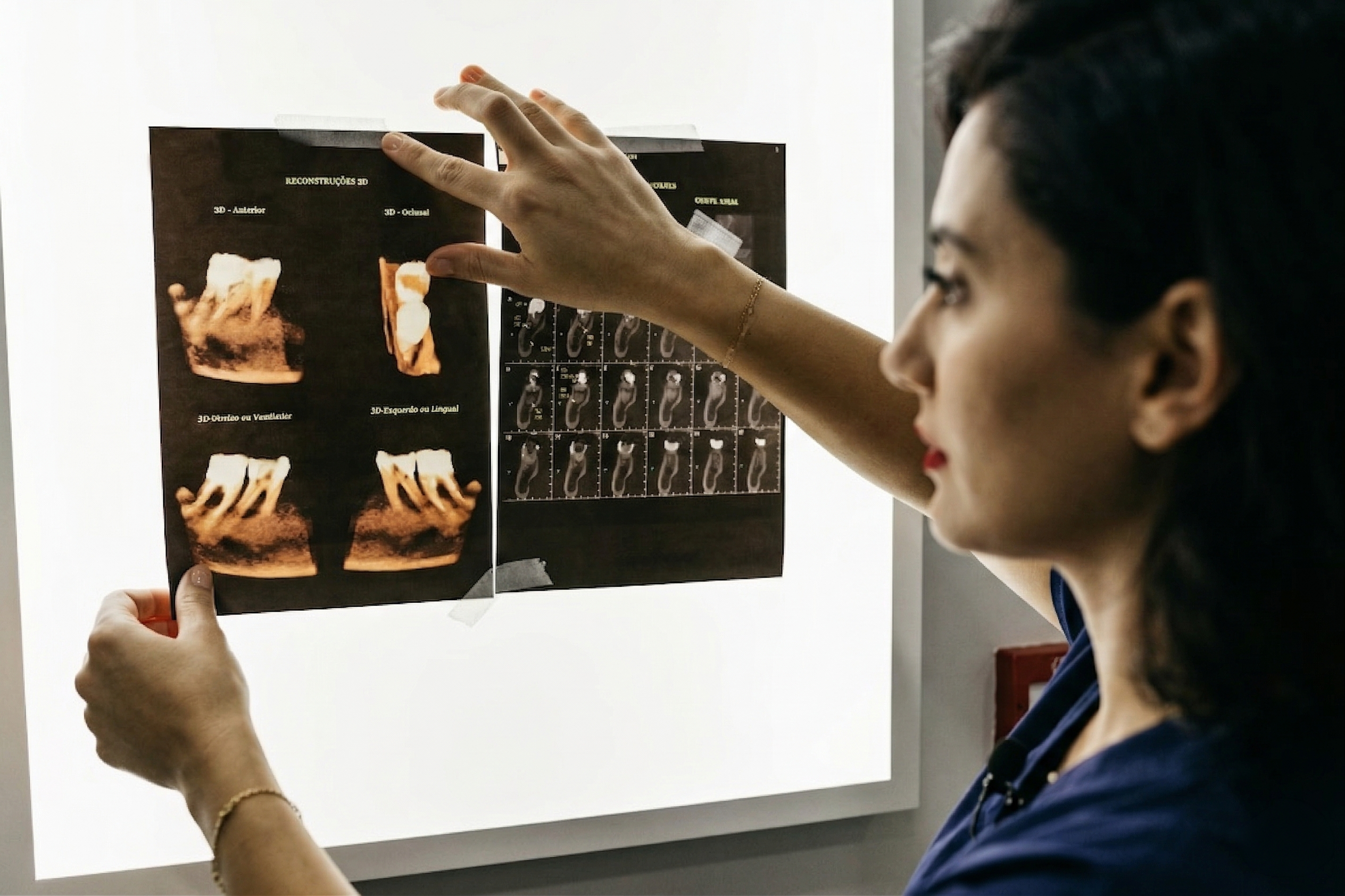 Kompozit Bonding Fiyatları. Kompozit bonding malzeme kalitesi ve çeşitleri